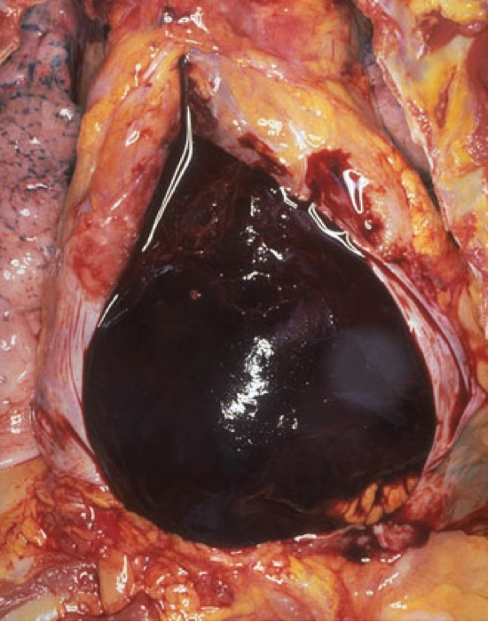 pericardial-clot